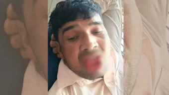 সাবেক প্রেমিকাকে চুমু, কামড়ে ছিন্ন প্রেমিকের জিহ্বা