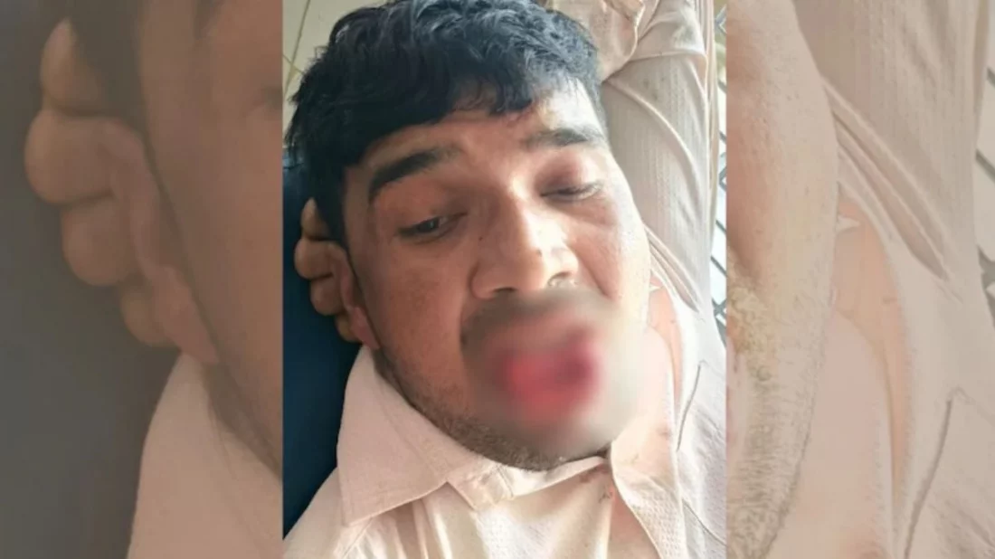 সাবেক প্রেমিকাকে চুমু, কামড়ে ছিন্ন প্রেমিকের জিহ্বা