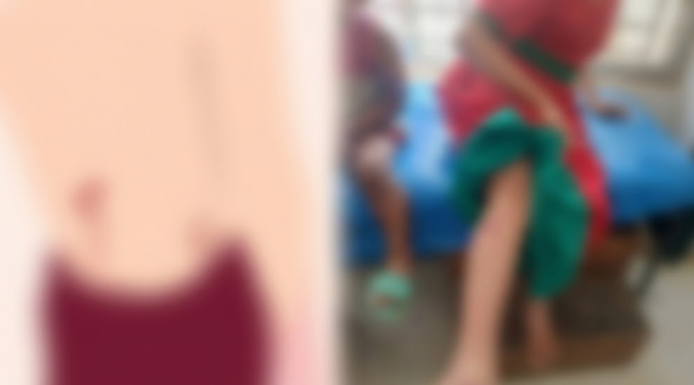হবিগঞ্জে পাগলা কুকুরের কামড়ে স্কুল ছাত্রীসহ আ হ ত অর্ধশত